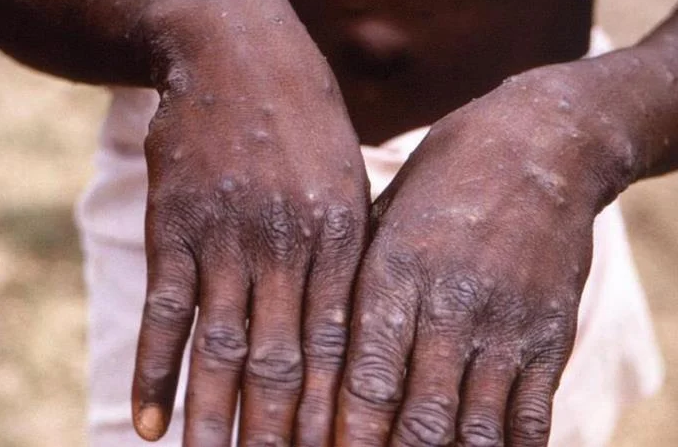 Salud Pública notifica primer caso sospechoso de viruela símica en República Dominicana