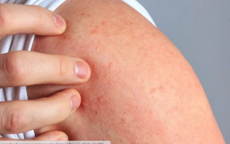 La Dermatitis Atópica: enfermedad crónica que afecta a 1 de cada 10 personas