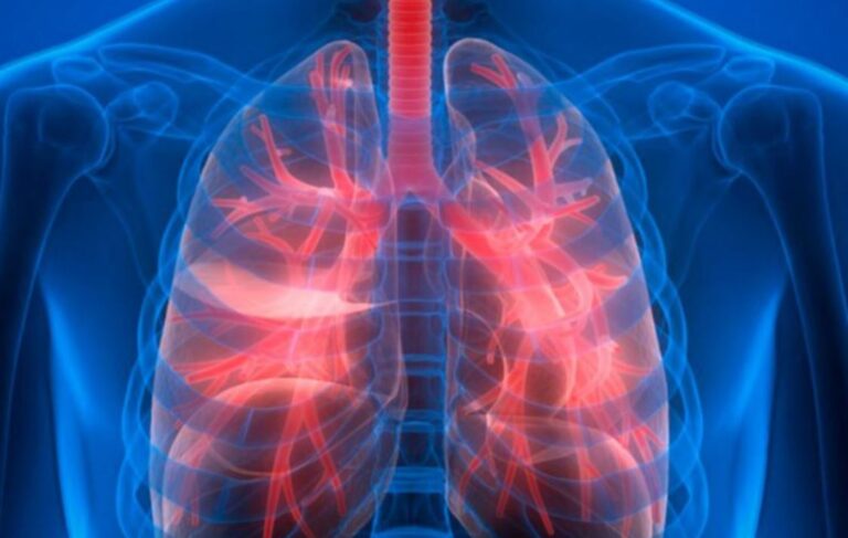 Más de 65 millones de personas sufren de enfermedad pulmonar obstructiva crónica